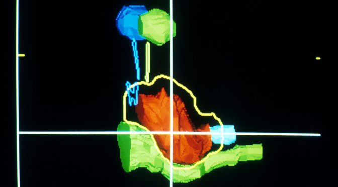 Proton Beam Therapy